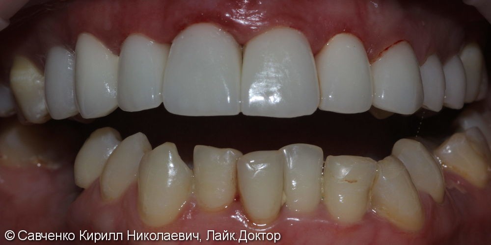 Протезирование зубов с помощью ВИНИРОВ из прессованной керамики E-MAX - фото №2
