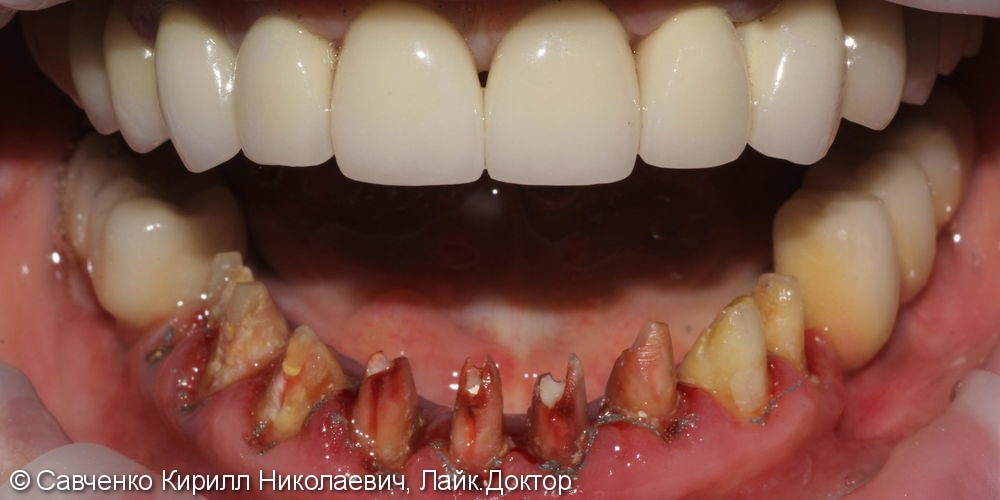 Перепротезирование зубов с помощью безметалловых коронок из диоксида циркония - фото №1