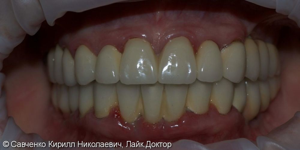 Перепротезирование зубов с помощью безметалловых коронок из диоксида циркония - фото №2