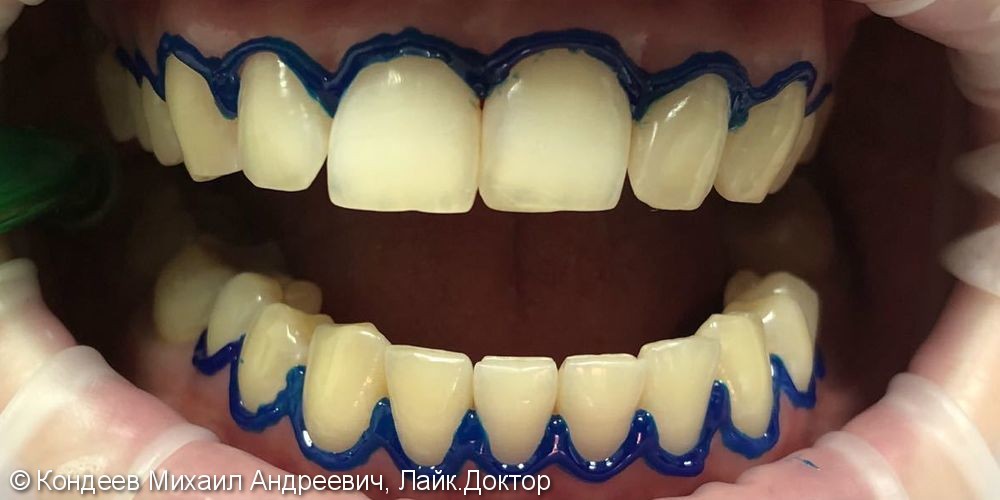 Результат комплексной чистки и профессионального отбеливания зубов Зум, до и после - фото №1