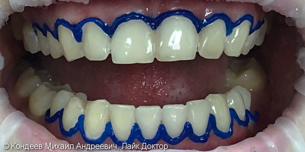 Результат комплексной чистки и профессионального отбеливания зубов Зум, до и после - фото №2