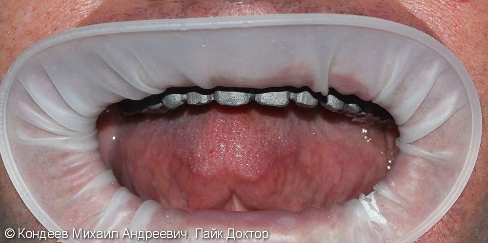 Восстановление зубного ряда нижней и верхней челюстях при полной адентии - фото №1