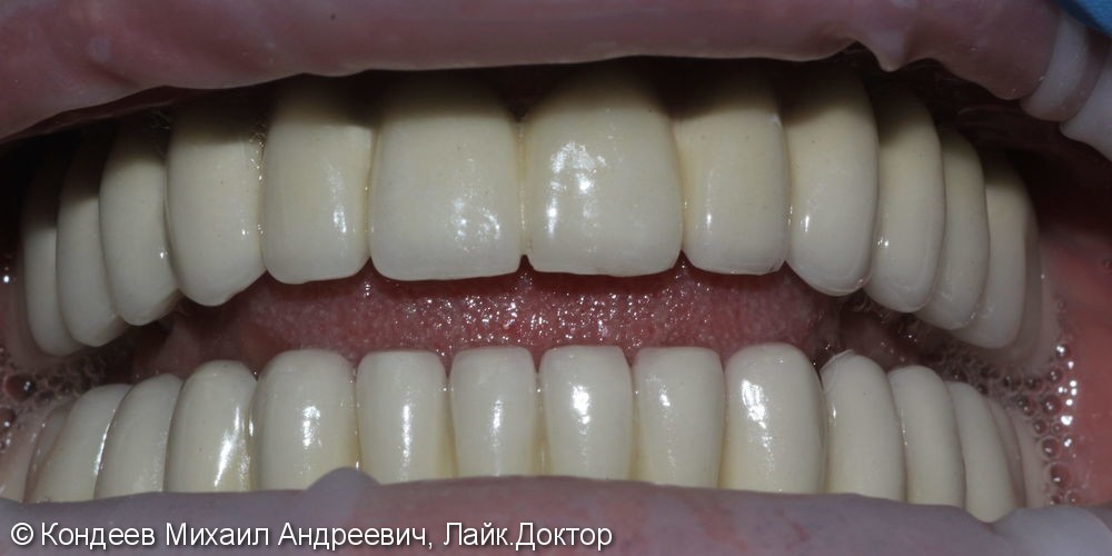 Восстановление зубного ряда нижней и верхней челюстях при полной адентии - фото №2