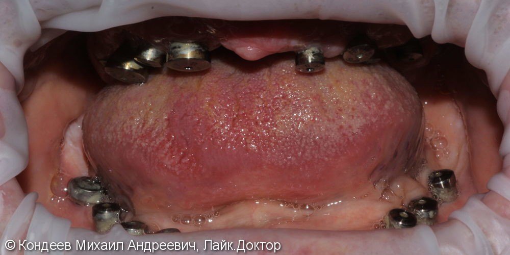 Восстановление зубного ряда нижней и верхней челюстях при полной адентии SNUCONE - фото №1