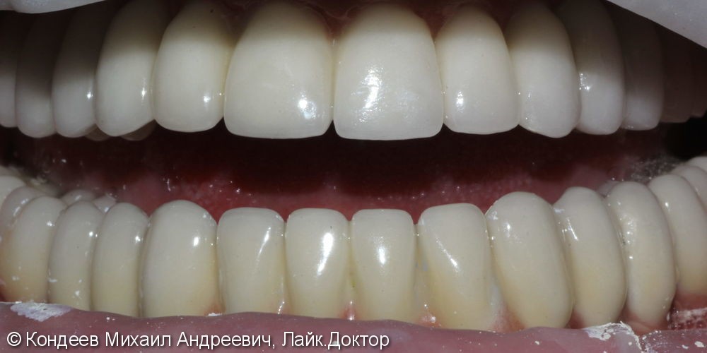 Восстановление зубного ряда нижней и верхней челюстях при полной адентии SNUCONE - фото №2