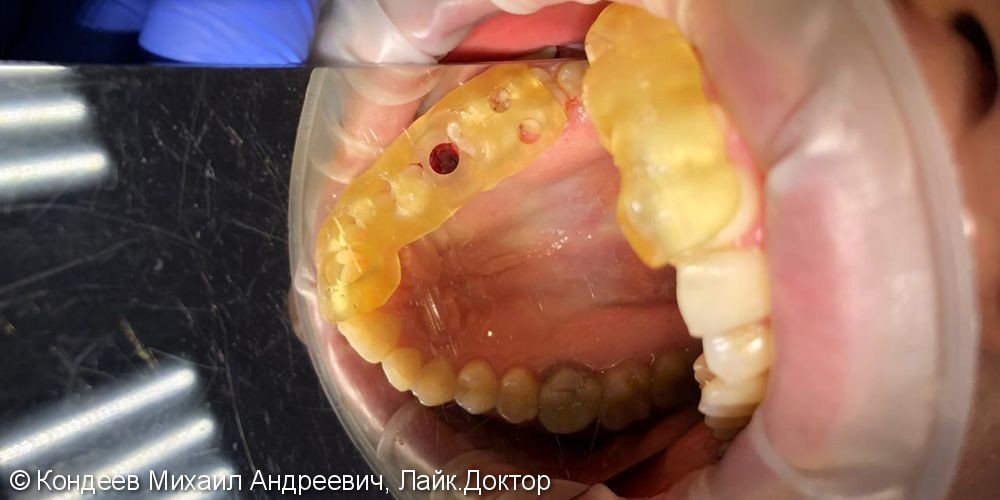 Имплантация зуба по хирургическому 3D шаблону с одномоментной нагрузкой - фото №1