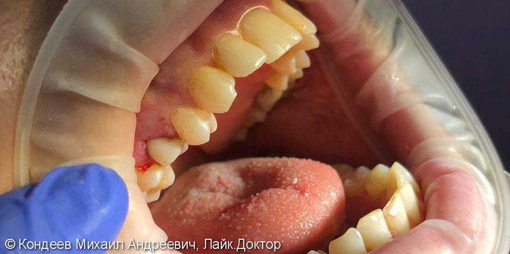 Имплантация зуба по хирургическому 3D шаблону с одномоментной нагрузкой - фото №2