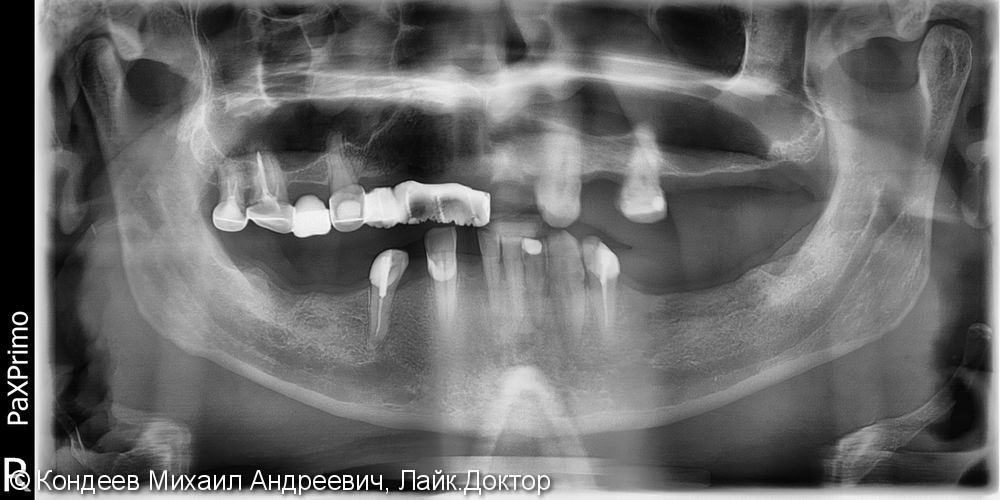 Восстановление зубного ряда нижней и верхней челюстях с помощью имплантантов SNUCONE - фото №1