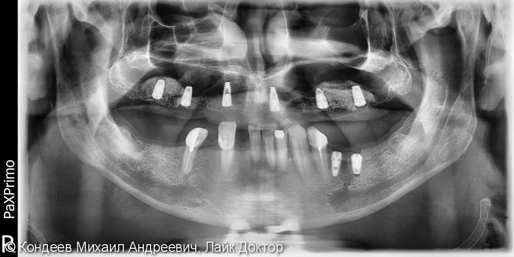 Восстановление зубного ряда нижней и верхней челюстях с помощью имплантантов SNUCONE - фото №2