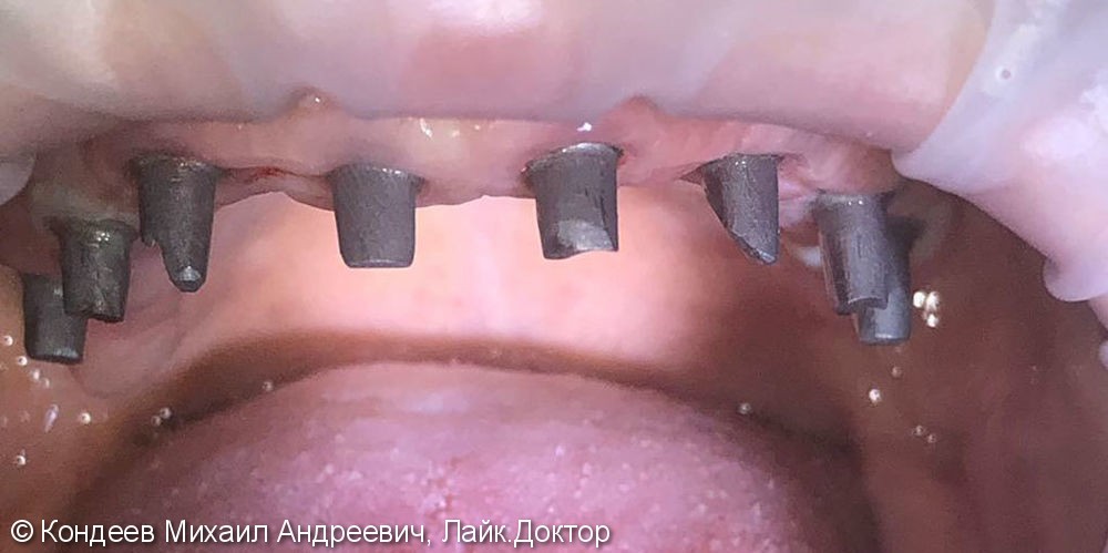 Восстановление зубного ряда нижней и верхней челюстях при частчиной адентии с помощью имплантантов SNUCONE - фото №1