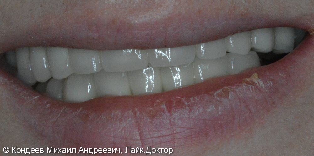Восстановление зубного ряда нижней и верхней челюстях при частчиной адентии с помощью имплантантов SNUCONE - фото №2