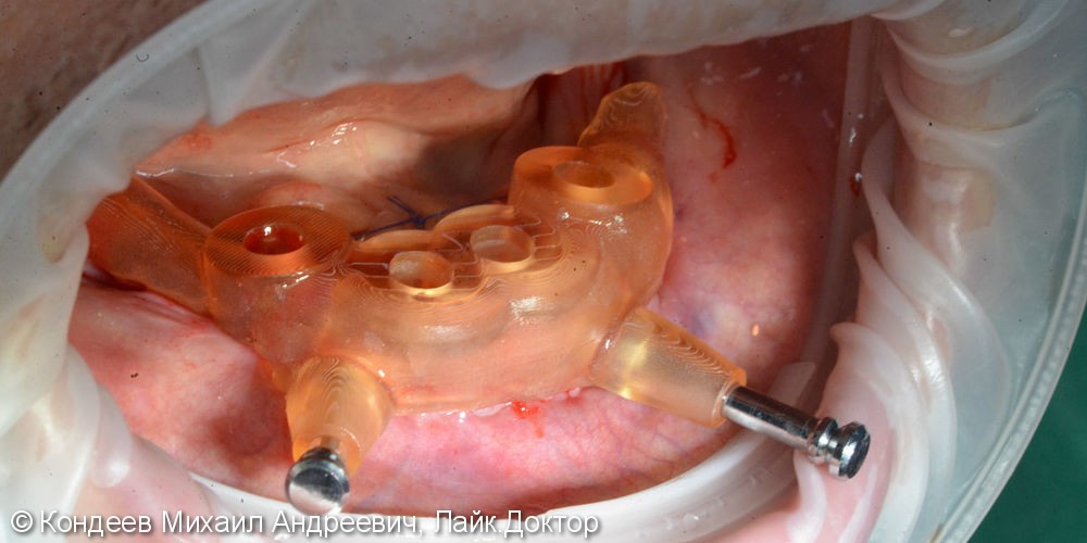 Восстановление зубного ряда нижней челюсти при полной адентии с помощью Имплантатов по системе «ALL ON 4» - фото №2