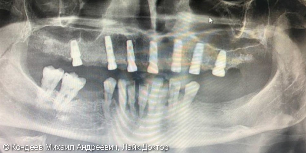 Восстановление зубного ряда верхней челюстях с помощью имплантантов - фото №2