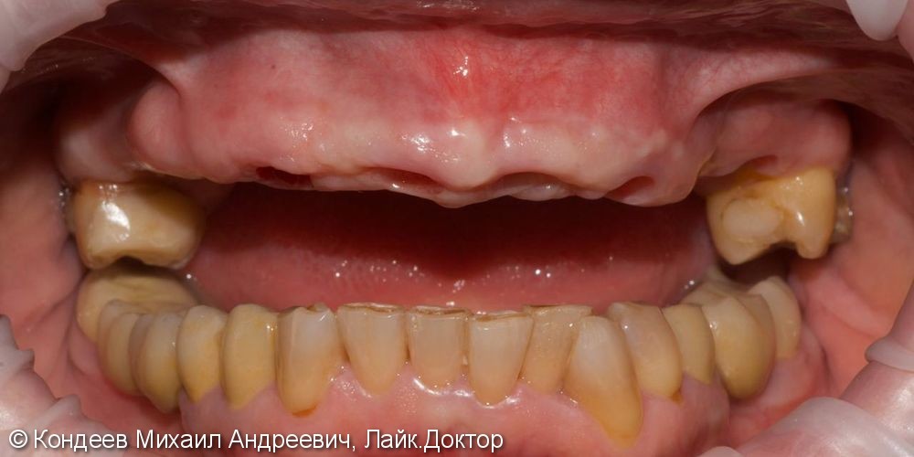 Восстановление зубного ряда верхней челюсти при частичной адентии с помощью имплантантов - фото №1