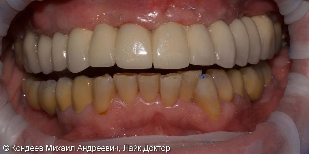Восстановление зубного ряда верхней челюсти при частичной адентии с помощью имплантантов - фото №2
