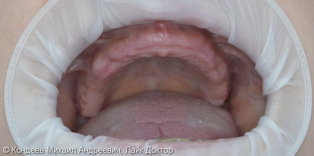 Восстановление зубов по системе ALL ON 4 за 2 дня - фото №1