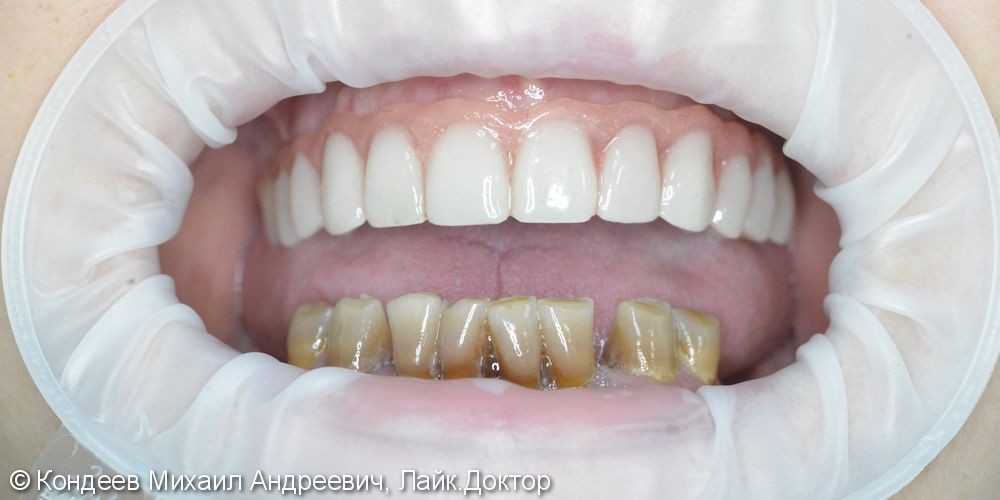 Восстановление зубов по системе ALL ON 4 за 2 дня - фото №3