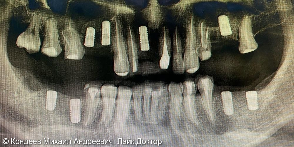 Восстановление зубного ряда с помощью дентальных имплантатов STRAUMANN - фото №1