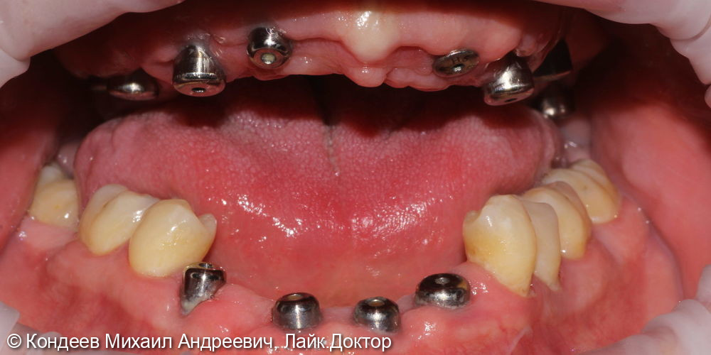 Восстановление зубного ряда нижней и верхней челюстях - фото №1