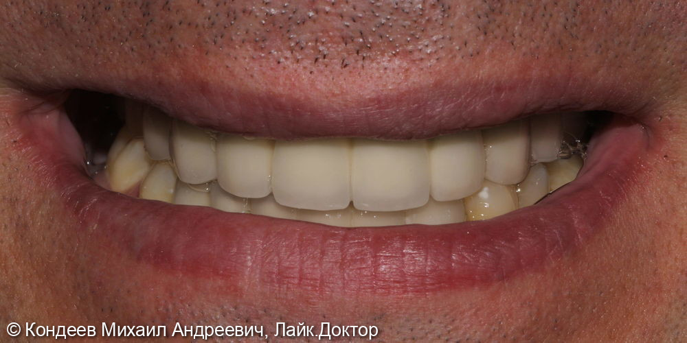 Восстановление зубного ряда нижней и верхней челюстях - фото №2