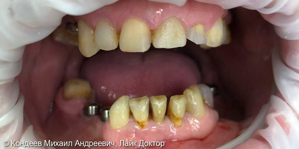 Восстановление зубного ряда с помощью дентальных имплантатов OSSTEM + протезирование с помощью Циркониевых коронок - фото №1