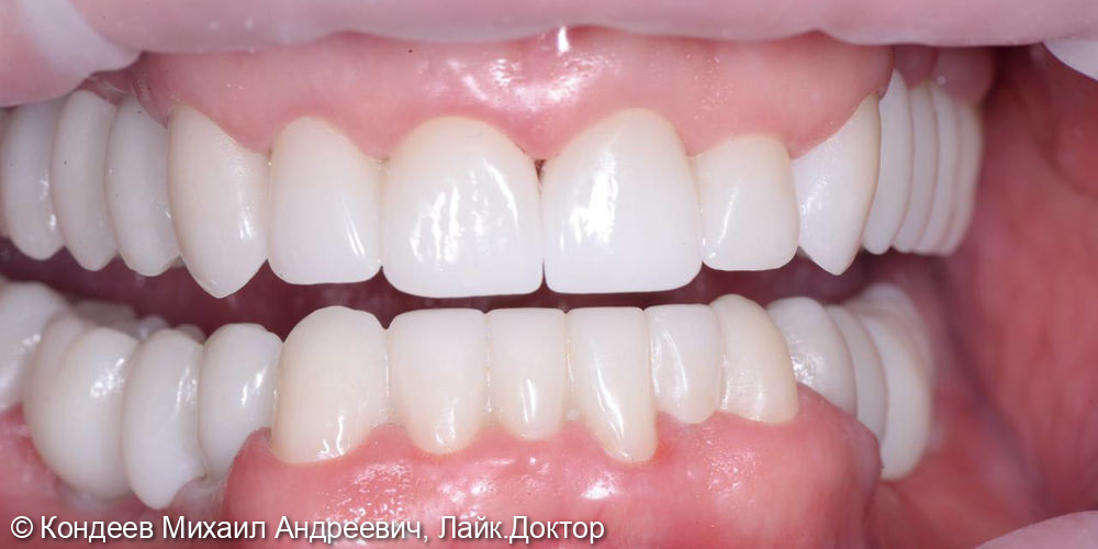 Восстановление зубного ряда с помощью дентальных имплантатов OSSTEM + протезирование с помощью Циркониевых коронок - фото №2