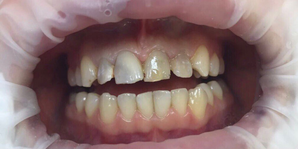 Эндодонтическое лечение и реставрация передних зубов - фото №1