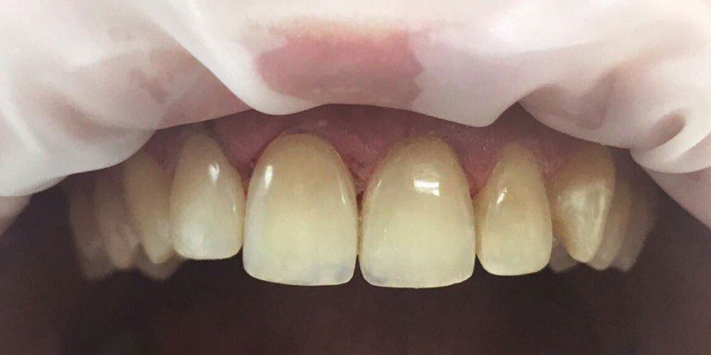 Реставрация зубов фронтальной группы зубов композитными материалами - фото №2