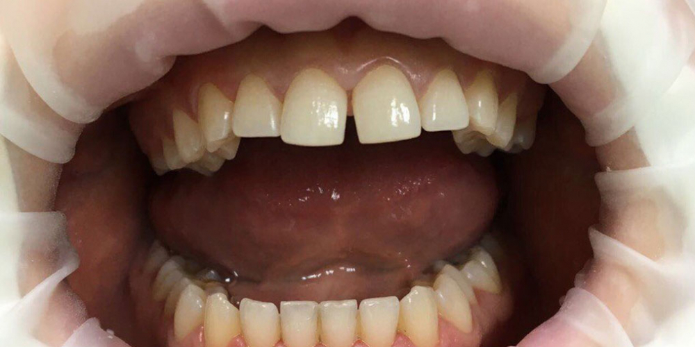 Эстетическая реставрация центральных резцов с восстановлением анатомической формы зубов - фото №1