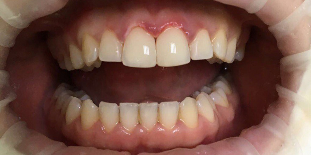 Эстетическая реставрация центральных резцов с восстановлением анатомической формы зубов - фото №2