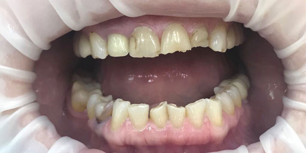 Художественная реставрация фронтальных зубов нанокомпозитным материалом Estelite ASTERIA - фото №1
