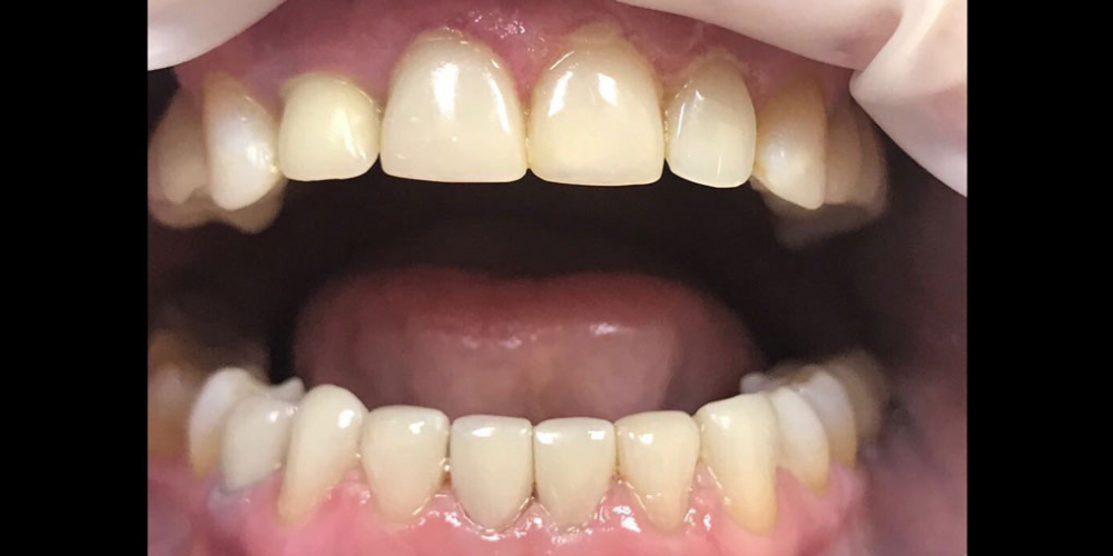 Художественная реставрация фронтальных зубов нанокомпозитным материалом Estelite ASTERIA - фото №2