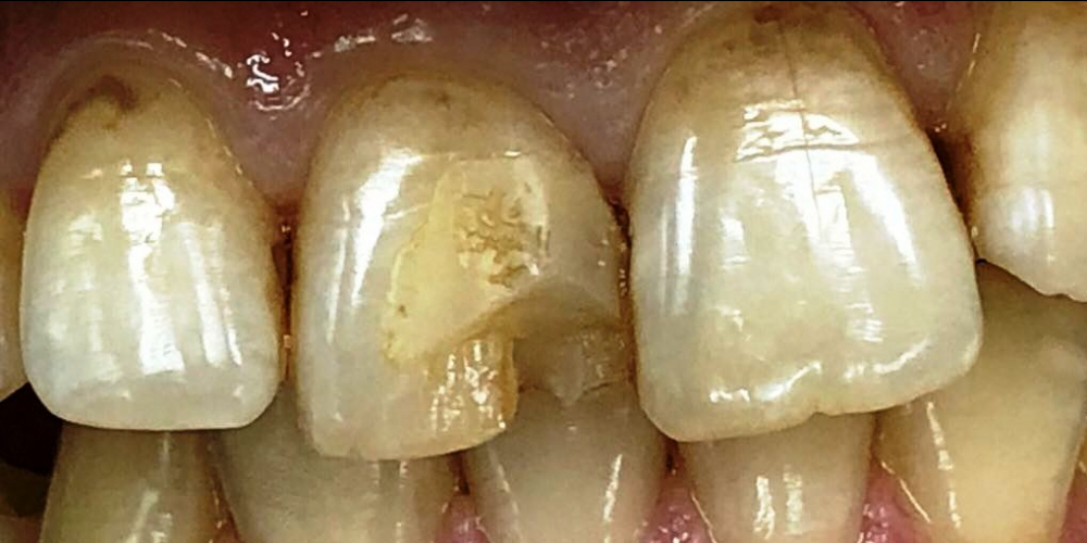 Реставрация переднего зуба под местным обезболиванием - фото №1