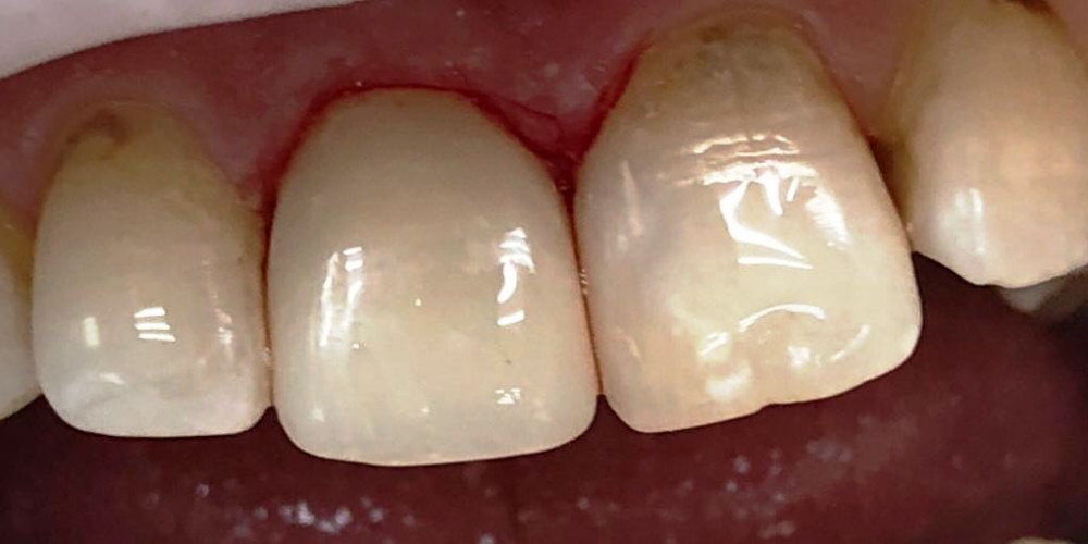 Реставрация переднего зуба под местным обезболиванием - фото №2
