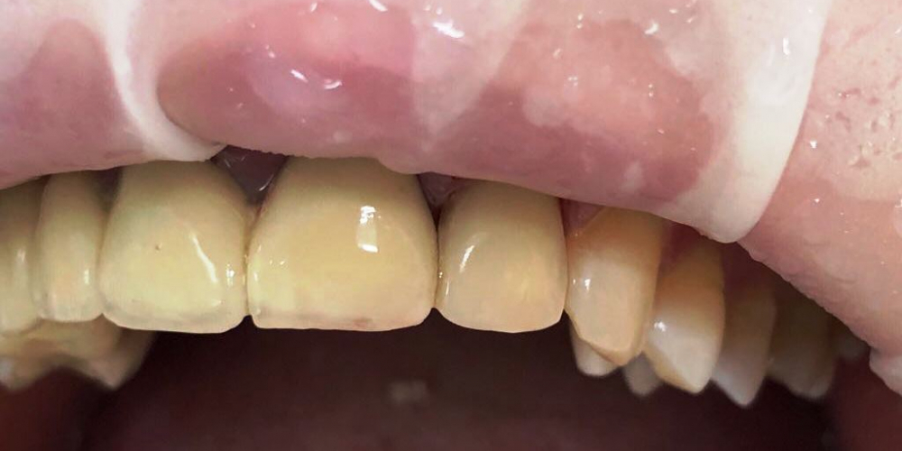 Эндодонтическое лечение и реставрация зуба - фото №2