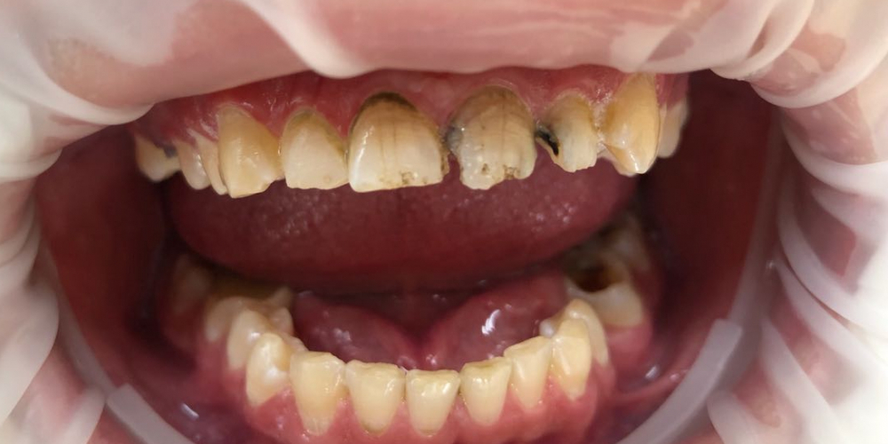 Художественная реставрация фронтальныx зубов нанокомпозитным материалом Estelite ASTERIA - фото №1