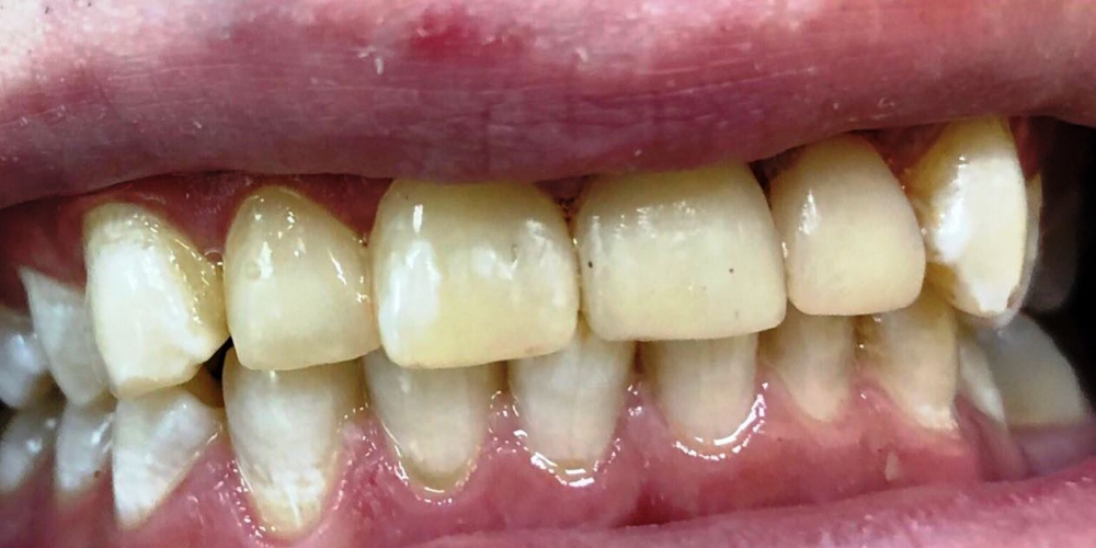 Художественная реставрация фронтальныx зубов нанокомпозитным материалом Estelite ASTERIA - фото №2