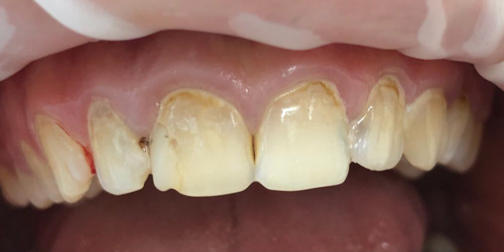 Восстановление анатомической формы зубов и реставрация зубов - фото №1