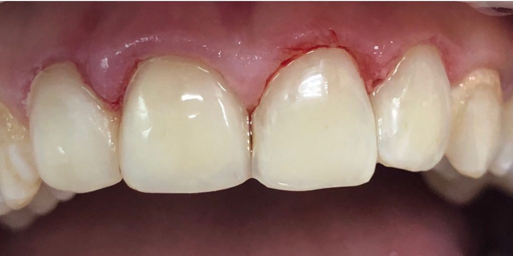 Восстановление анатомической формы зубов и реставрация зубов - фото №2