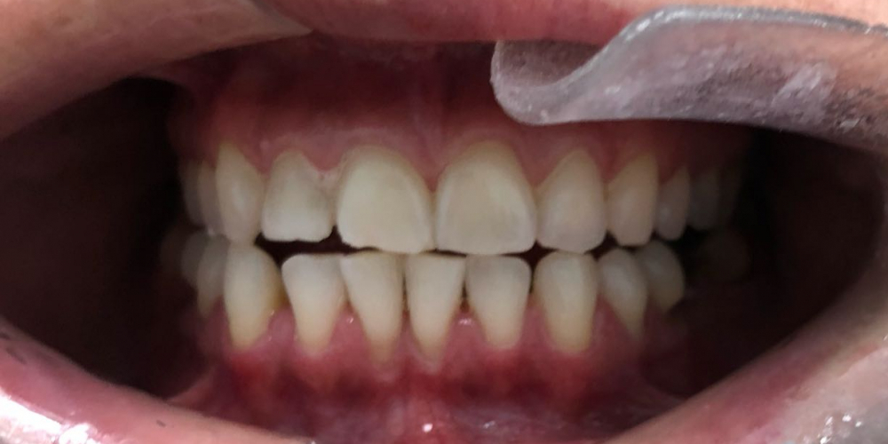 Отбеливание зубов системой ZOOM, результат до и после - фото №1