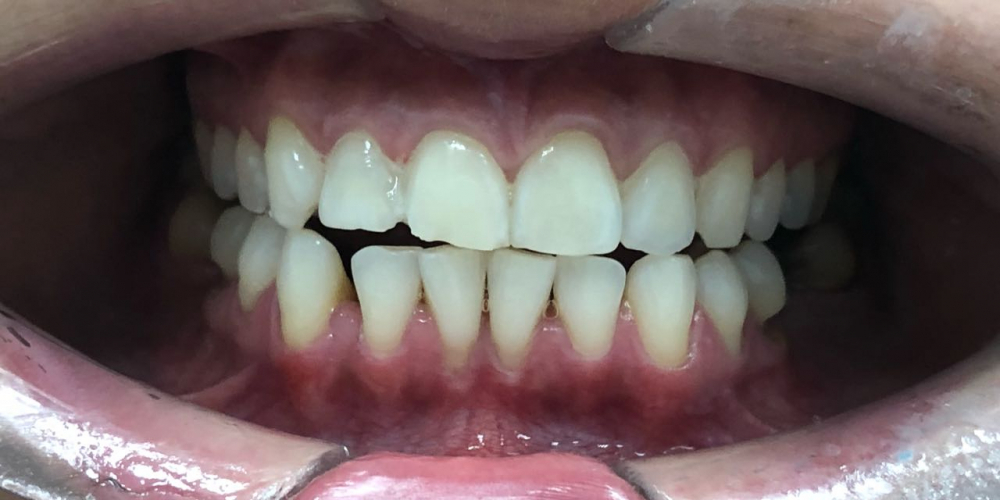 Отбеливание зубов системой ZOOM, результат до и после - фото №2