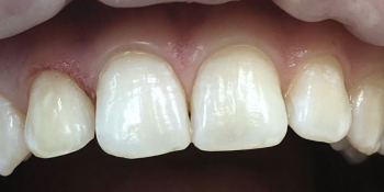 Реставрация зубов фронтального отдела - фото №2