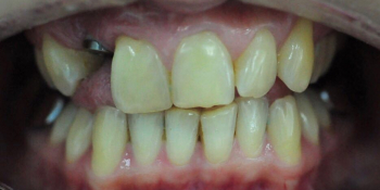 Отбеливание зубов системой ZOOM, фото до и после - фото №1
