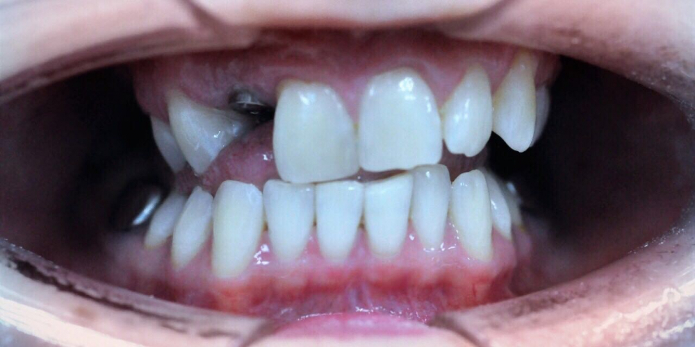 Отбеливание зубов системой ZOOM, фото до и после - фото №2