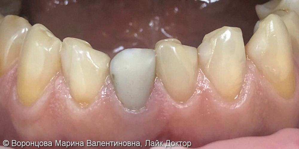Реставрация центральных зубов на нижней челюсти, до и после - фото №1