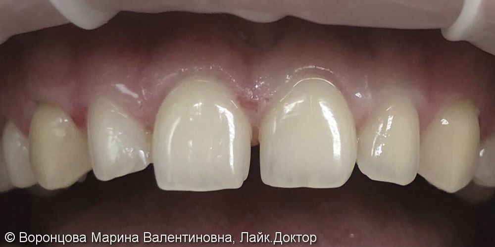 Устранение диастемы между центральными зубами, до и после - фото №1