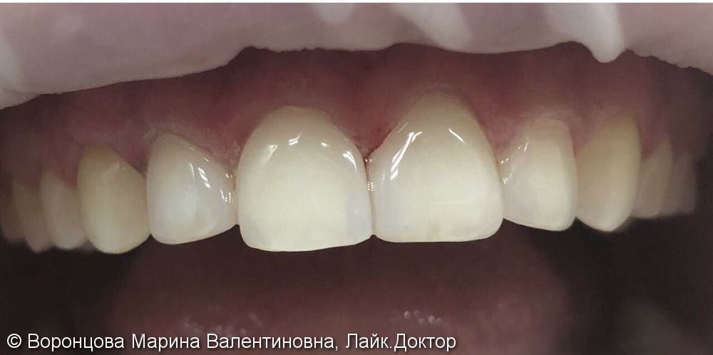 Устранение диастемы между центральными зубами, до и после - фото №2