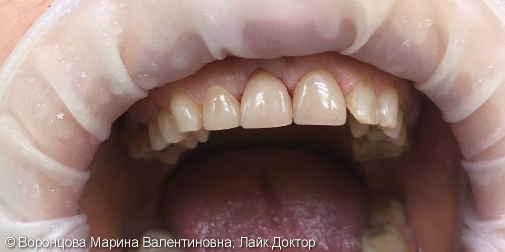 Художественная реставрация передних зубов, до и после - фото №2