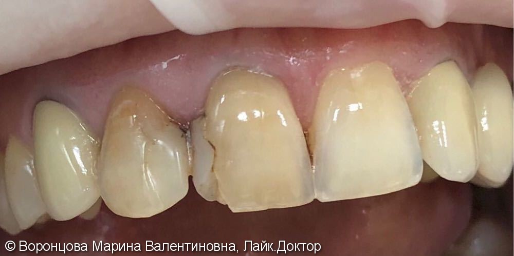 Художественная реставрация косметического дефекта зубов 1.1 и 1.2 - фото №1
