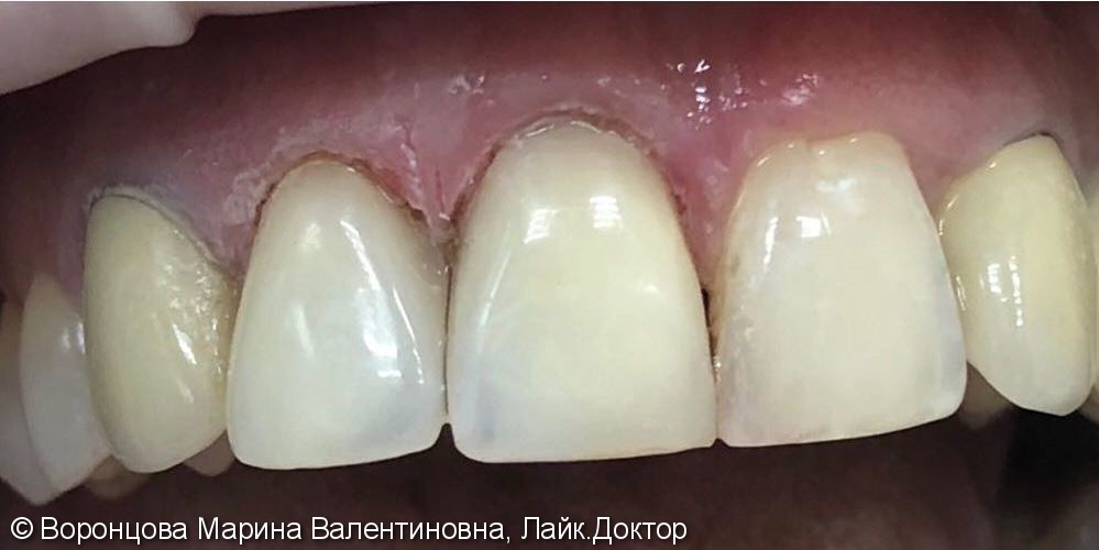 Художественная реставрация косметического дефекта зубов 1.1 и 1.2 - фото №2